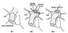玻尿酸男性生殖整形有必要吗