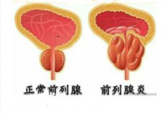 前列腺增生的最佳治疗方法