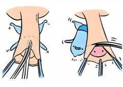 男性尿道修复是大手术吗