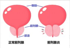 男性前列腺炎怎么调理治愈