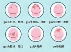 男性生殖性感染做什么检查