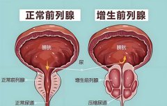 男性前列腺增生是什么原因引起的