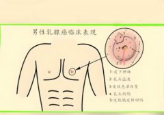 男性乳腺癌可以治愈吗