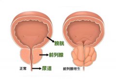 前列腺增大是怎么回事