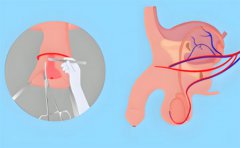 包皮疤痕怎么去除