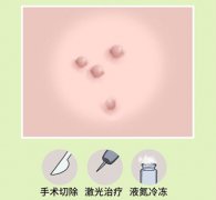男性根部长了凸起肉粒
