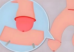 包皮手术多久能恢复好