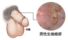 男性生殖感染怎么处理好