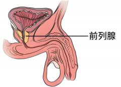 前列腺炎怎么治疗才能彻底好