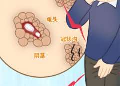 感染hpv有什么症状表现