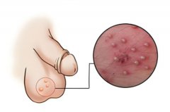 男性生殖外皮有小疙瘩是怎么回事