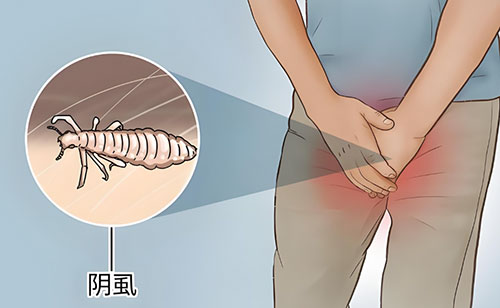 阴虱怎么处理才能干净