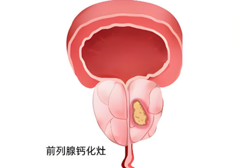 前列腺钙化灶是怎么回事严重吗