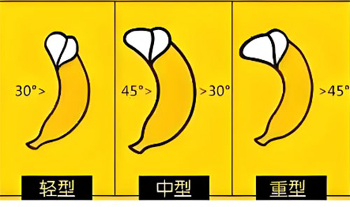 男性生殖弯曲是怎么引起的