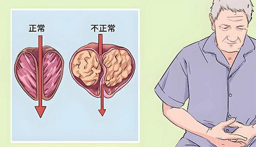 前列腺钙化灶是一种什么病症
