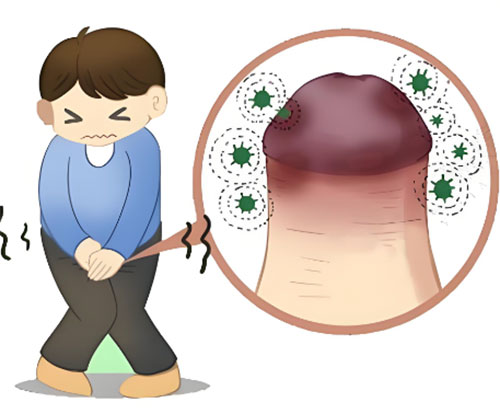 龟头发炎是什么原因引起的