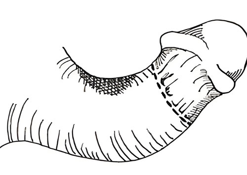 男性向上弯曲是什么原因