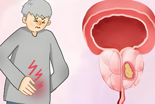 前列腺钙化了怎么治