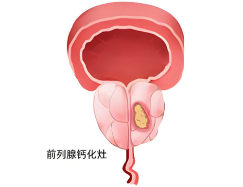 前列腺钙化灶是什么情况