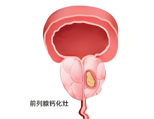 前列腺钙化灶怎么治疗怎么消除