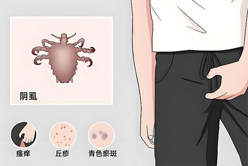 阴虱用什么药物可以彻底根除
