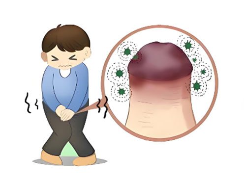 龟头发炎用什么药效果好