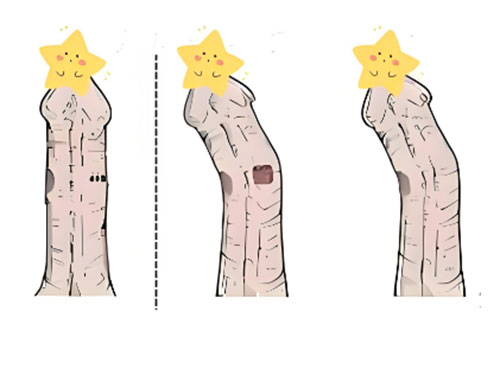 丁丁弯曲怎么办