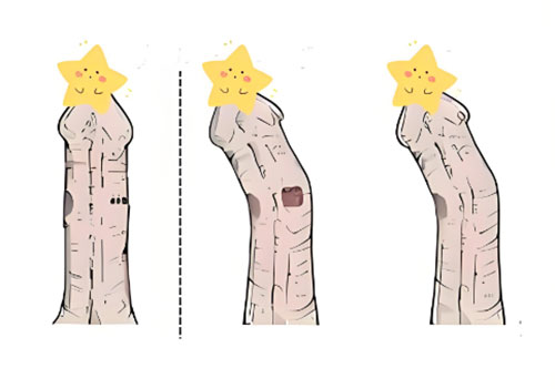 丁丁弯曲会导致女方疼痛吗