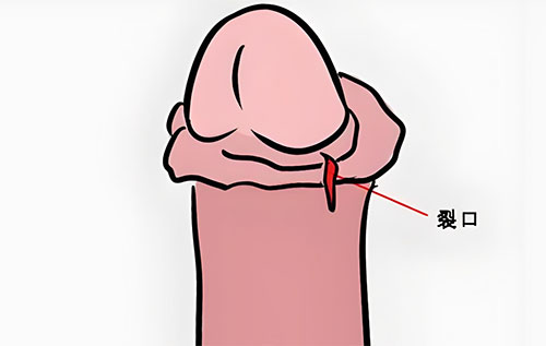 包皮裂口子是怎么回事