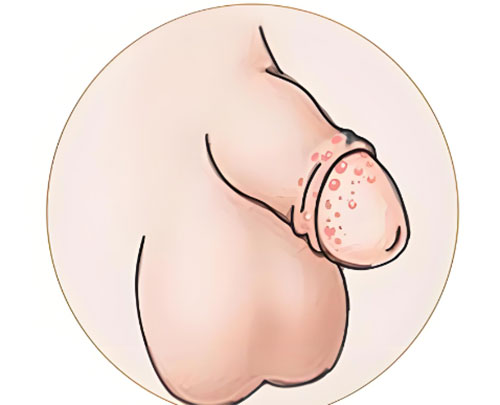 包皮上长水泡是什么原因