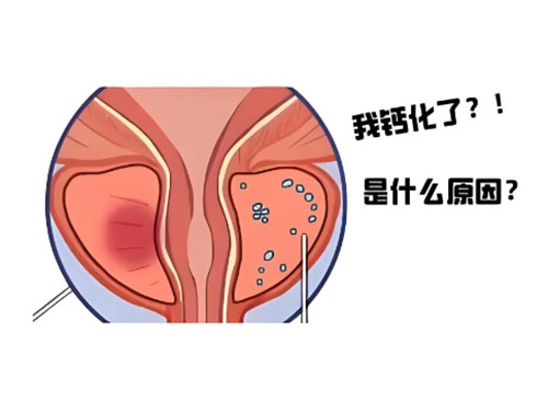 前列腺钙化怎么治疗怎么消除