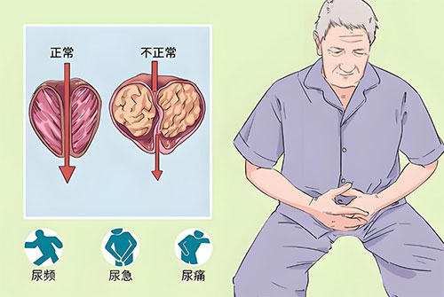 前列腺钙化灶吃什么药好得快