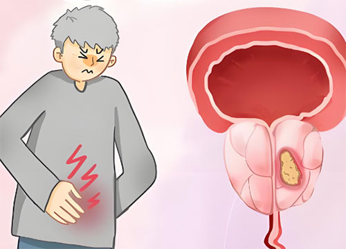 前列腺钙化会影响男性性功能吗