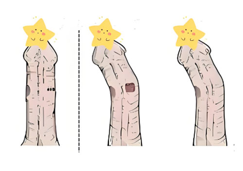 丁丁向左歪是怎么回事