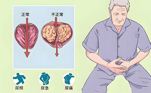 前列腺钙化灶会影响性功能吗