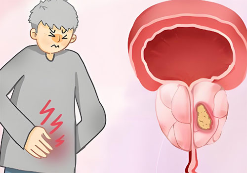 前列腺钙化好治疗吗