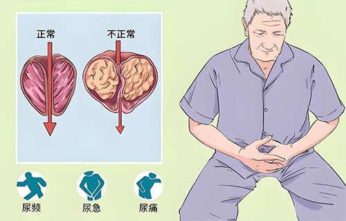 前列腺钙化灶是什么原因
