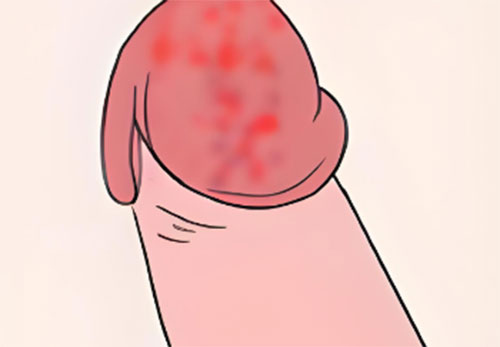 龟头上长了红斑是怎么回事