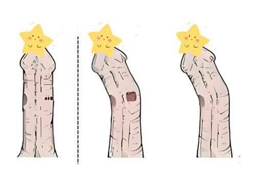 丁丁向左弯能矫正吗