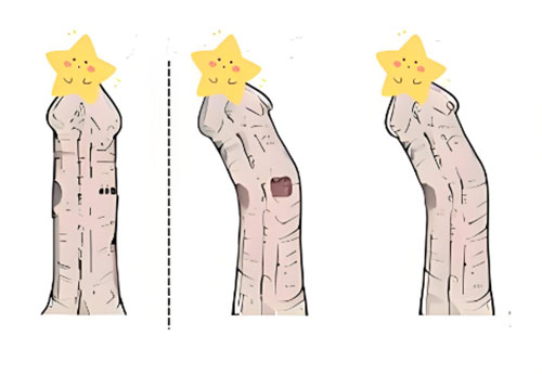 丁丁向左歪的矫正方法是什么