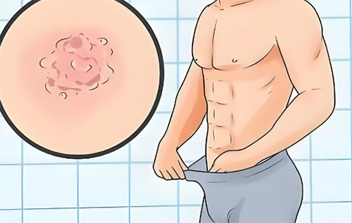 包皮长小水泡怎么回事