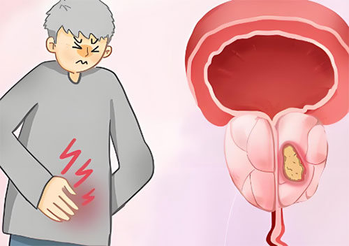 前列腺钙化是啥原因