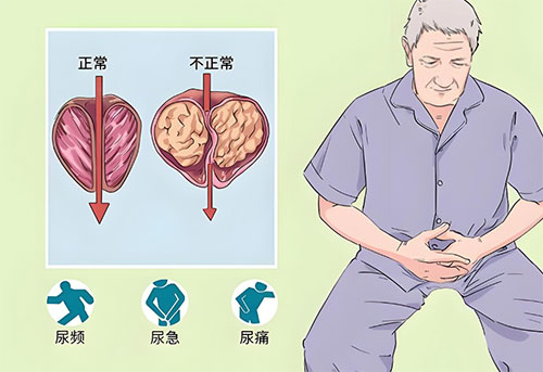 前列腺钙化灶有什么症状和危害