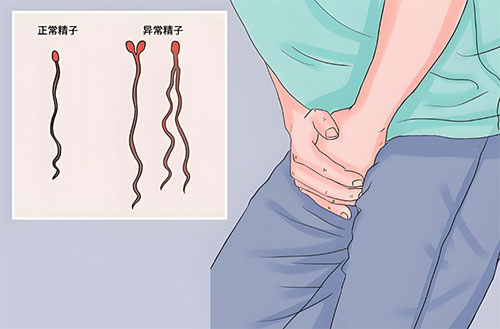 畸形精症可以怀孕吗