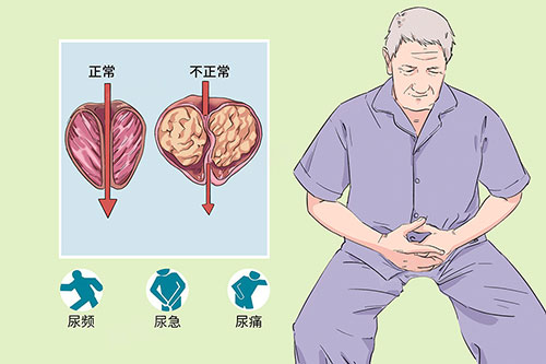 前列腺钙化灶能自愈吗