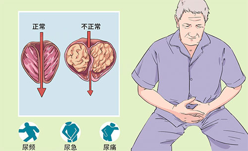 男士前列腺钙化是怎么回事