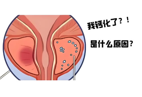 前列腺钙化灶是什么意思严重吗