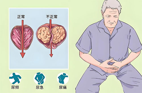 前列腺钙化灶是什么原因引起的
