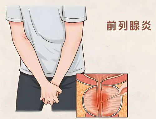得了前列腺炎能根治吗