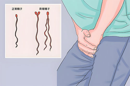 畸形精症会影响胎儿吗